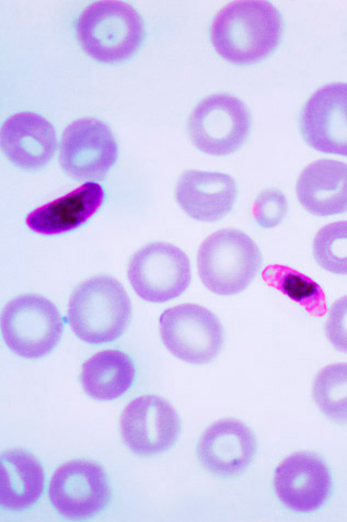 Plasmodium falciparum en sangre – CDC